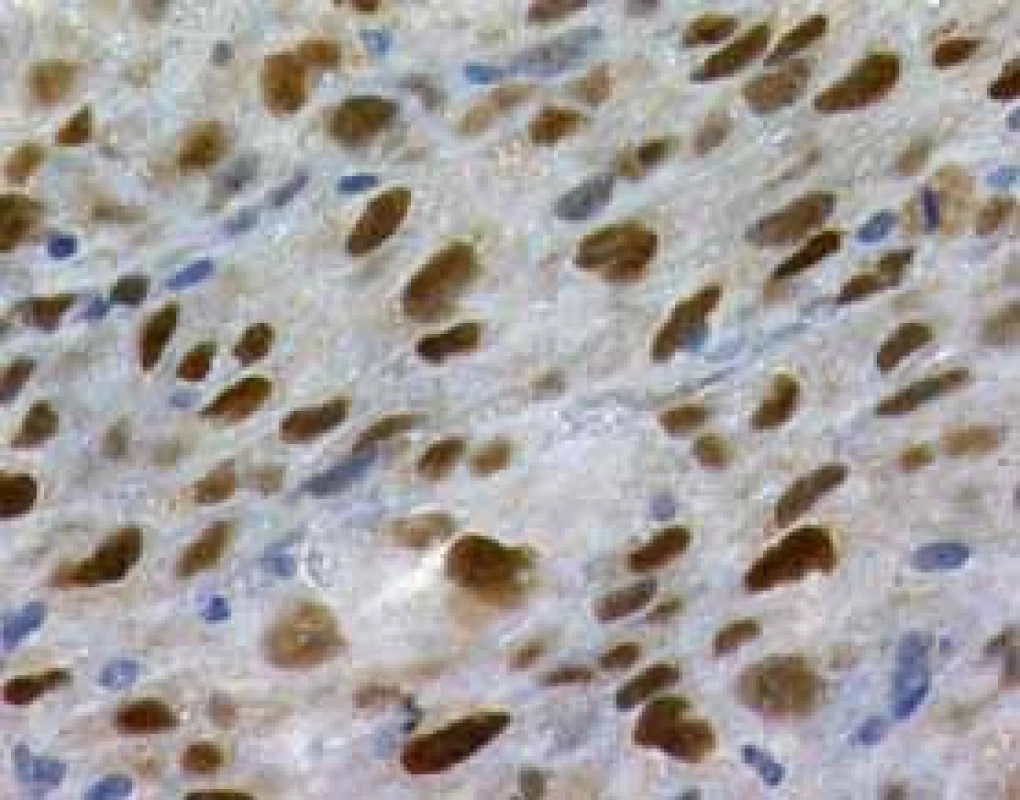 Uroteliální karcinom, vyšetření míry exprese p53, zvětšení 200×
Fig. 1. Urinary bladder carcinoma, immunohistochemistry of p53, 200×