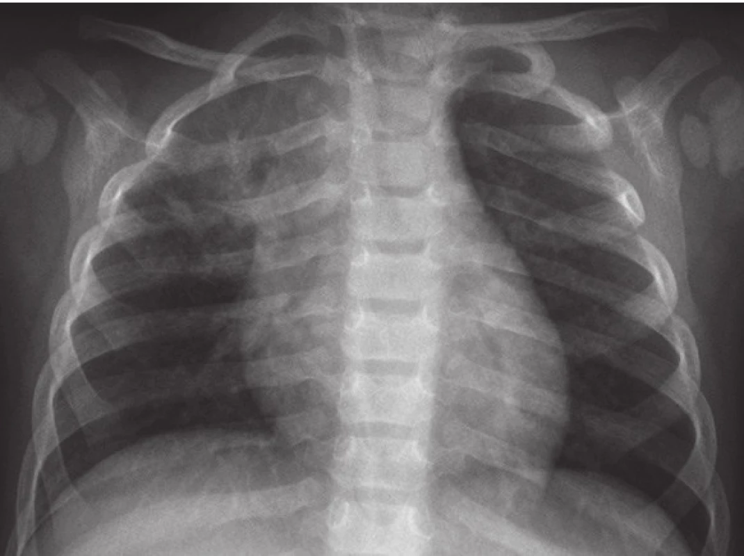 RTG snímek plic po 16 týdnech antituberkulózní terapie.
Fig. 4. Chest X-ray of infant after 16 weeks of treatment.