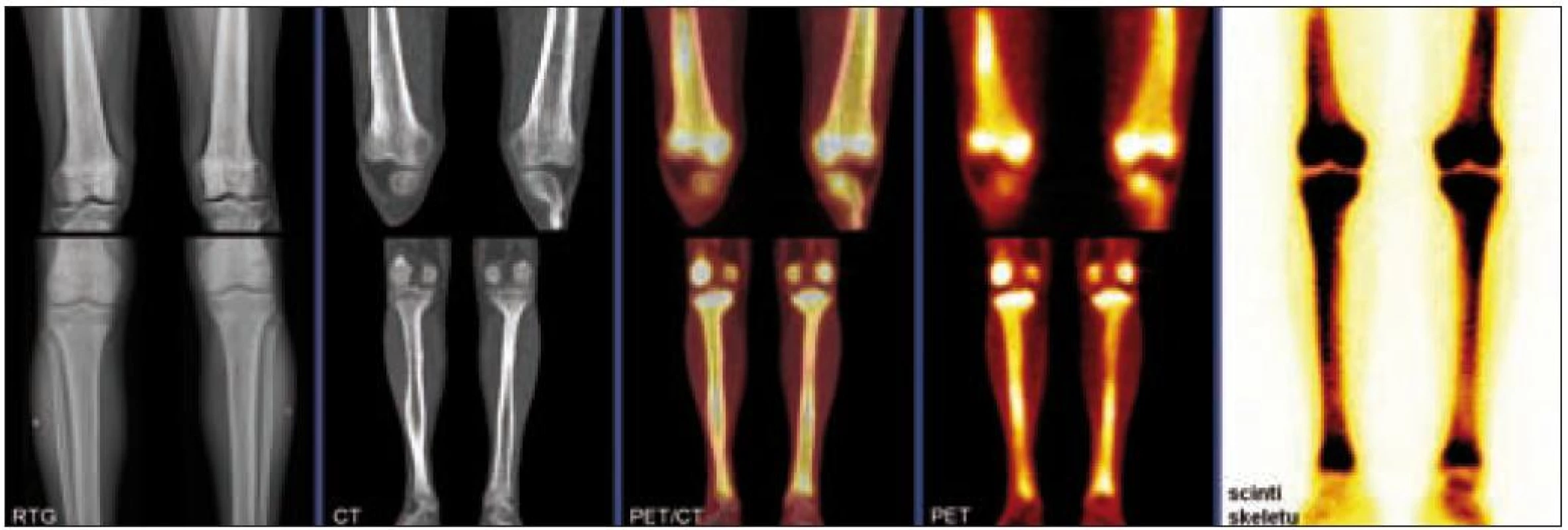 Postižení kostí dolních končetin u pacienta s Erdheimovou-Chesterovou chorobou, zobrazení pomocí konvenční radiografie (RTG), výpočetní tomografie (CT), pozitronové emisní tomografie (PET), hybridního PET/CT vyšetření a klasické kostní scintigrafie. Na RTG i CT je patrné oboustranné osteosklerotické postižení femorů a bércových kostí, které vykazuje patologický hypermetabolizmus glukózy na PET i zvýšenou akumulaci radiofarmaka (technecium pyrofosfátu) na scintigrafi i skeletu.