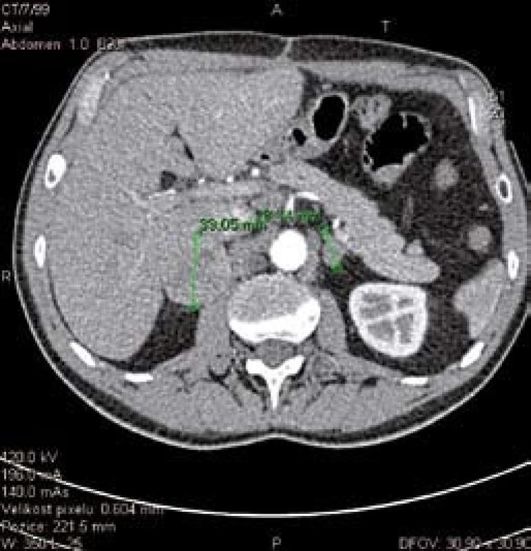 CT snímek zvětšených nadledvin.
Fig. 3. CT scan of enlarged adrenals.