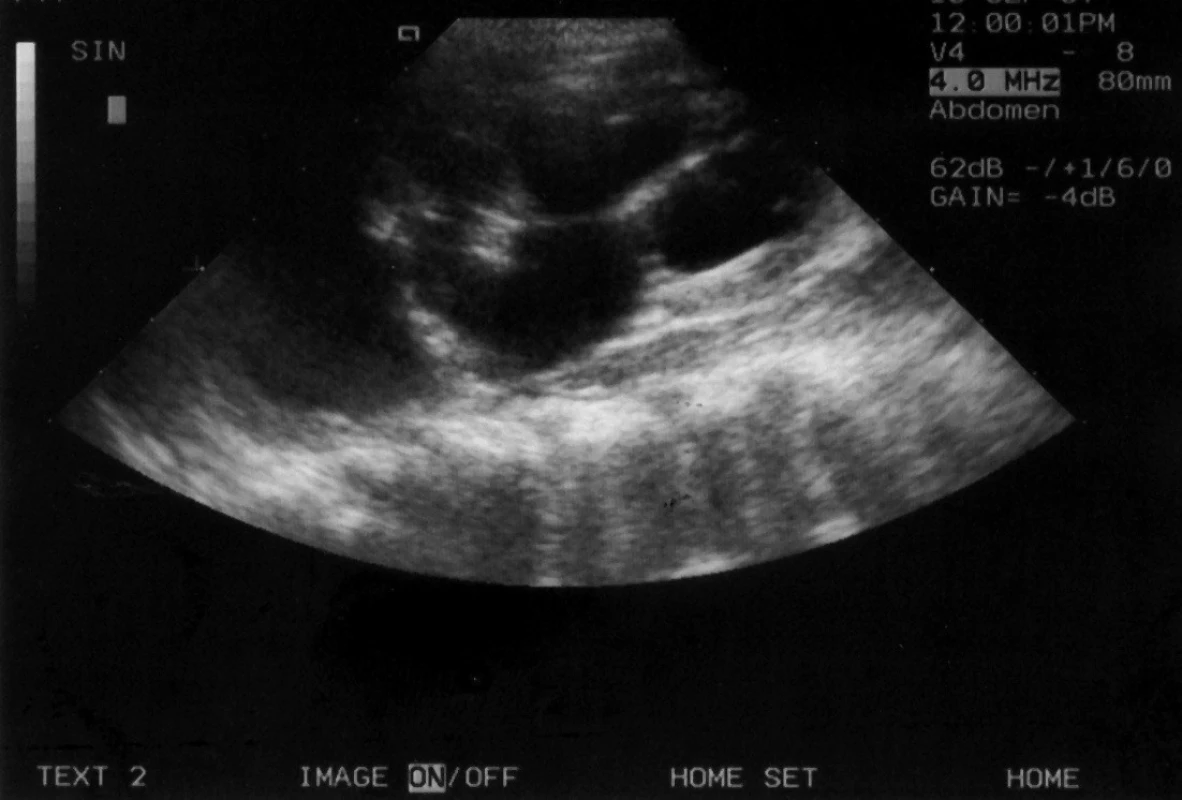 Kazuistika č. 2. Progrese hydronefrózy levé ledviny. Výrazná dilatace pánvičky a kalichů, zúžení parenchymu na 1 až 2 mm (normální šíře parenchymu v tomto věku je 8 mm). 
Fig. 3. Case report 2. There is a progression of hydronephrosis of the left kidney. A marked dilatation of the pelvis and calices, narrowed parenchyma to 1 to 2 mm (normal width of parenchyma at this age is 8 mm).