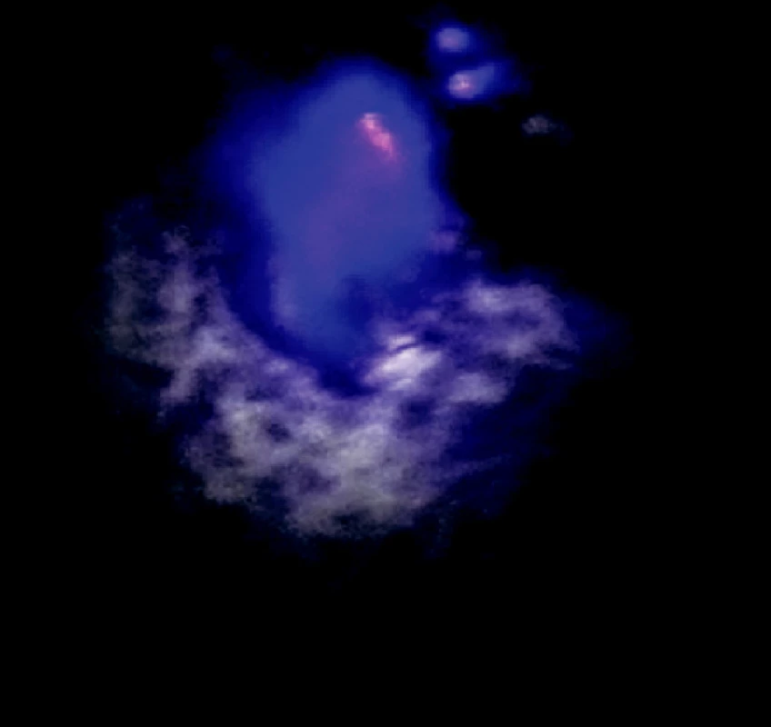 Ložisko adenokarcinómu na viscerálnej pleure v autofluorescenčnom obraze
Fig. 8. An autofluorescence view of the visceral pleura adenocarcinoma focus
