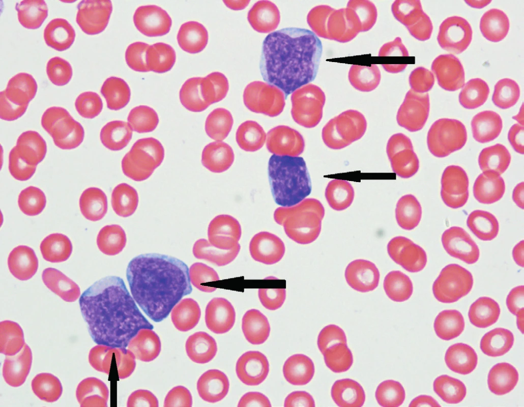 Patologické lymfocyty blastické varianty MCL (označeny šipkami) v nátěrech periferní krve