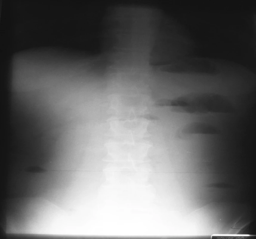 NSB – 18. 4. 2007 = kontrola na 4. deň hospitalizácie
Fig. 4. Native abdominal x-ray view – 18-04-2007 = a checkup on the 4th hospitalization day