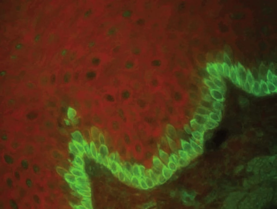 IF cytoplazmatické membrány bazálních buněk může být detekována v prebulózním stadiu bulózního pemfigoidu (nepřímá IF na opičím ezofagu, polyvalentní Ig)