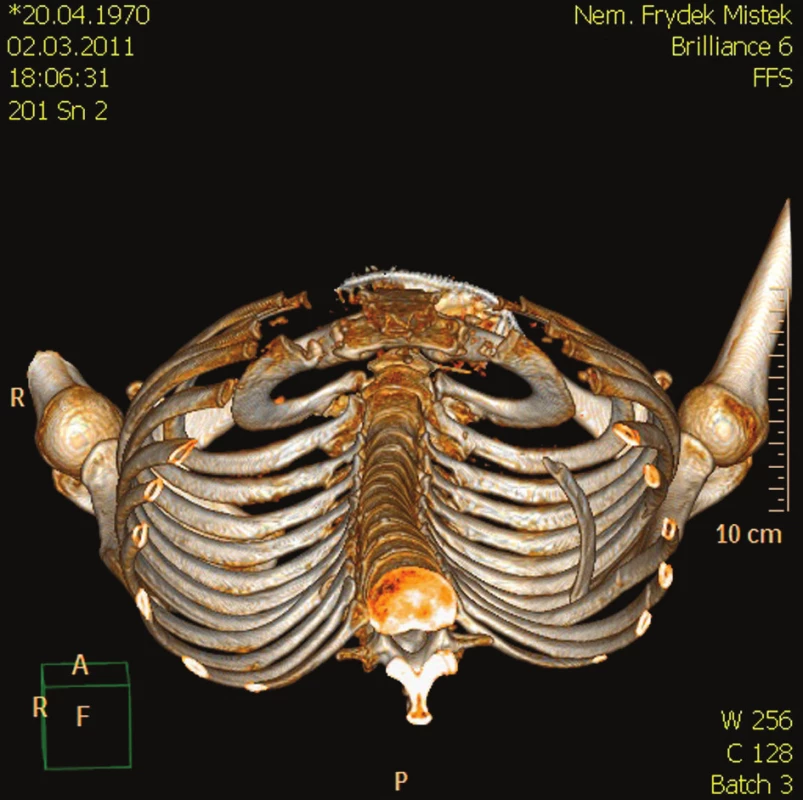 CT- 3D rekonstrukce skeletu hrudníku zobrazující dislokaci zlomeného VIII. žebra vlevo
Fig. 4. CT- 3D reconstruction of the thoracic cage, depicting dislocation of the fractured 8th rib on the left side