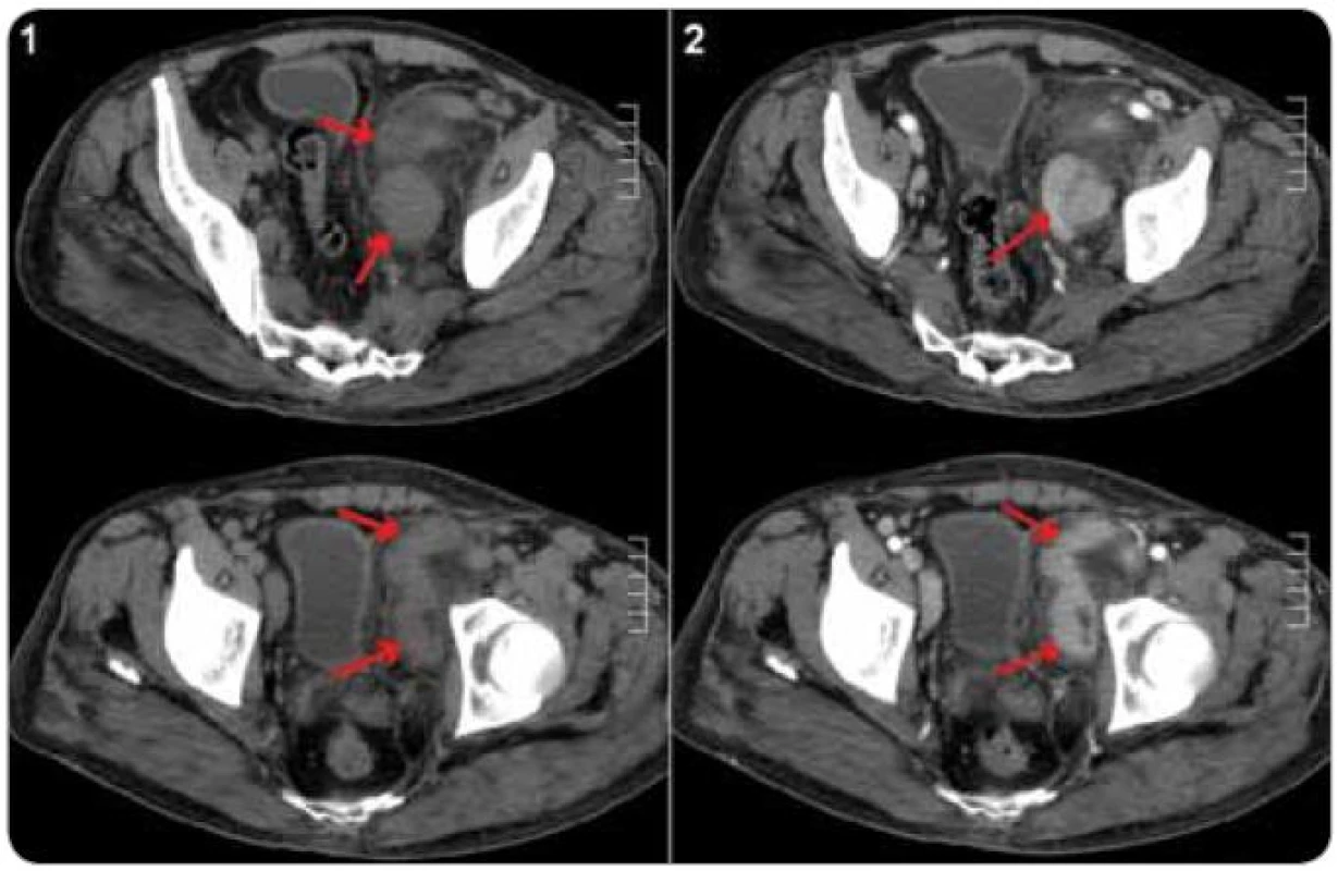 CT břicha u pacienta s plazmocelulární multicentrickou Castlemanovou chorobou.
Paket uzlin parailicky vlevo (šipky), nativní vyšetření (1) a po aplikaci kontrastní látky (2), kde je patrné homogenní sycení uzlin kontrastní látkou.