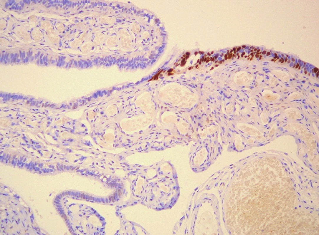 (A) Atypická (prostá) hyperplazie endometria (HE, 400x). (B) Endometriální intraepiteliální karcinom (HE, 600x). (C) Tubární intraepiteliální karcinom (HE, 400x). (D) P53 pozitivita v tubárním intraepiteliálním karcinomu (200x).