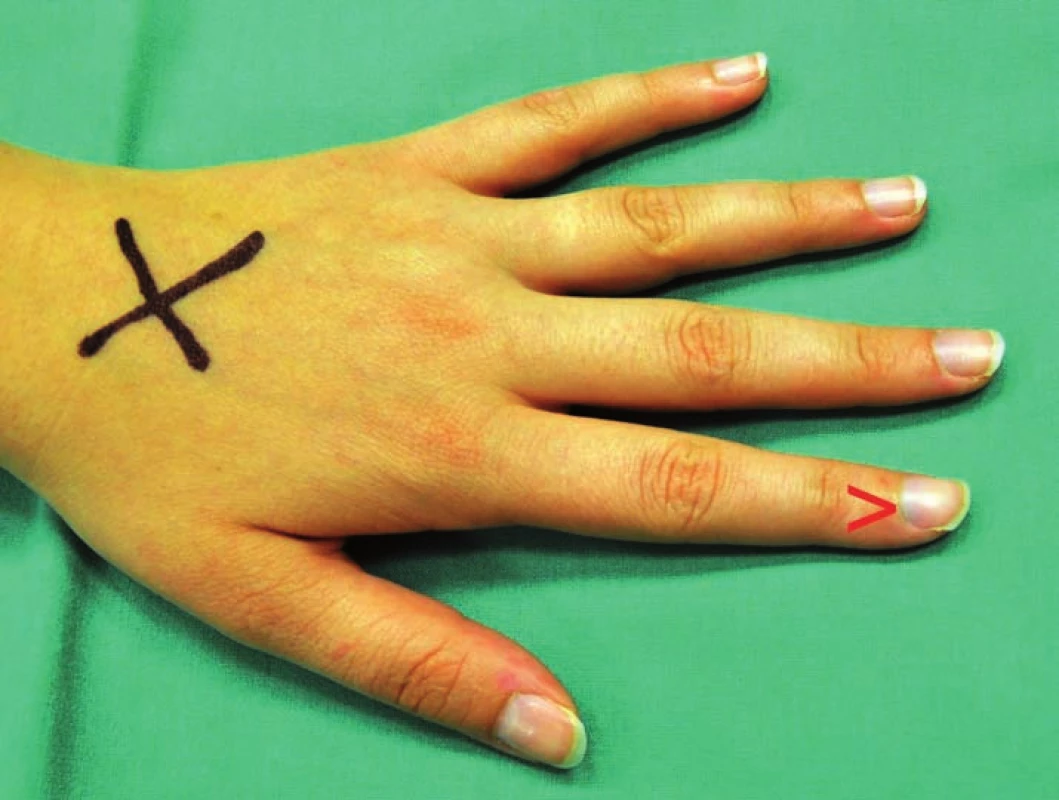Snímek levé ruky, šipka ukazuje modré zbarvení lunuly na radiální straně nehtu 2. prstu