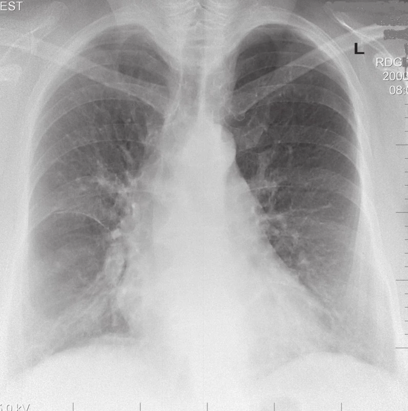 RTG obraz chronického štádia EAA typu pľúc chovateľov holubov u 63-ročného pacienta.