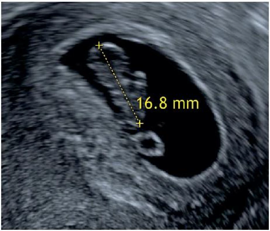 Průkaz neprosperující intrauterinní gravidity (embryo bez srdeční akce o CRL ≥ 7 mm)
Ultrazvukové zobrazení gestačního váčku s embryem bez patrné pulzace (srdeční akce) o maximální délce (CRL) 16,8 mm (odpovídá grav. hebd. 8+1).