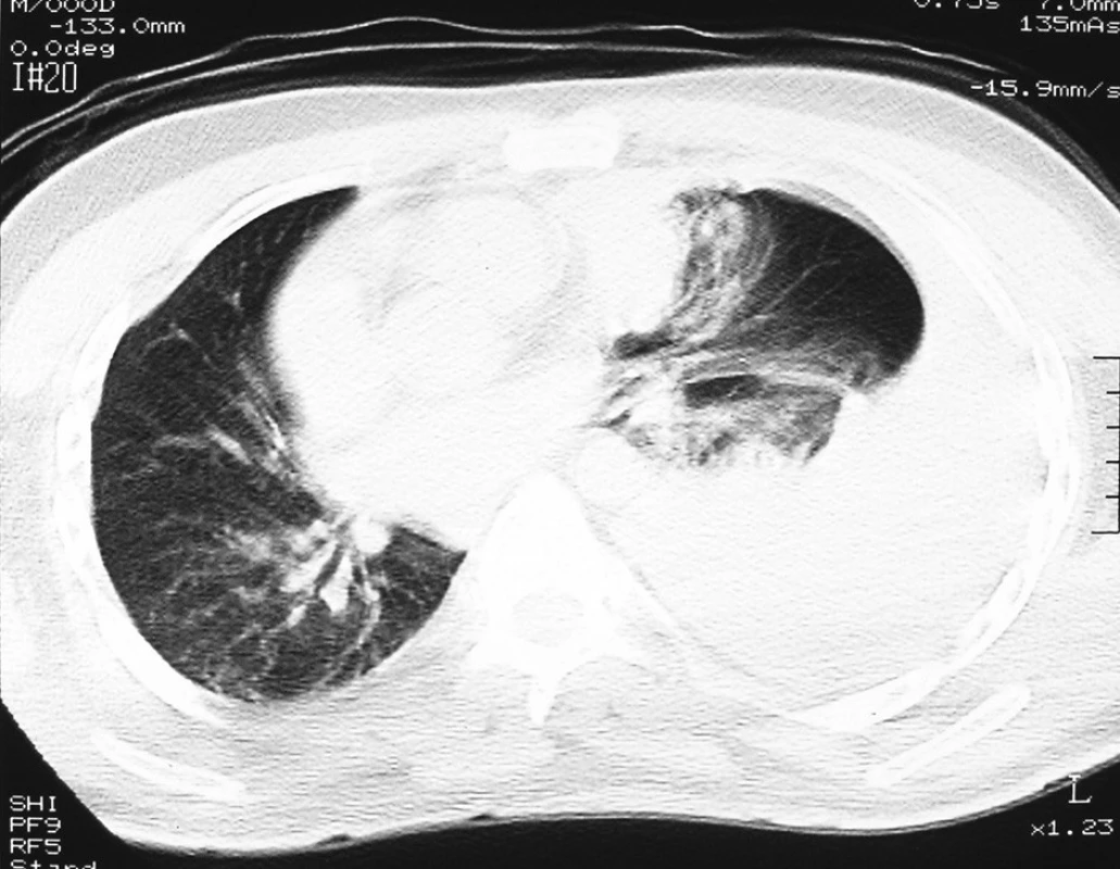 CT hrudníku, levostranný hemotorax
Fig. 3. CT of chest, haemothorax on the left side