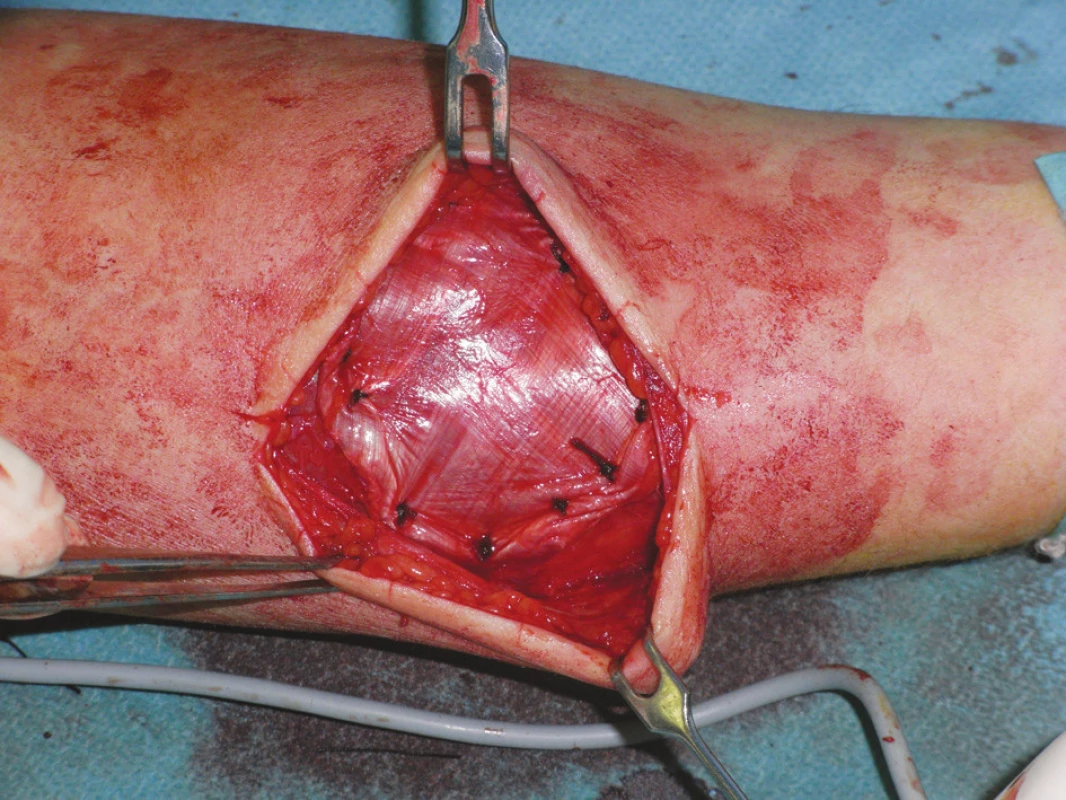 Onlay plastika hernie predlaktia
Fig. 3. Onlay- plasty of the forearm hernia