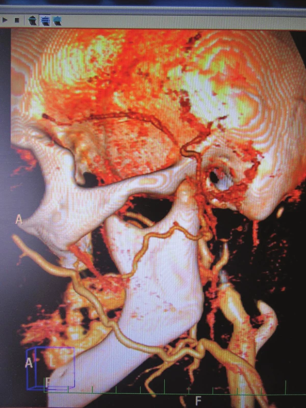 Angio CT – levá arteria temporalis s neostrou náplní