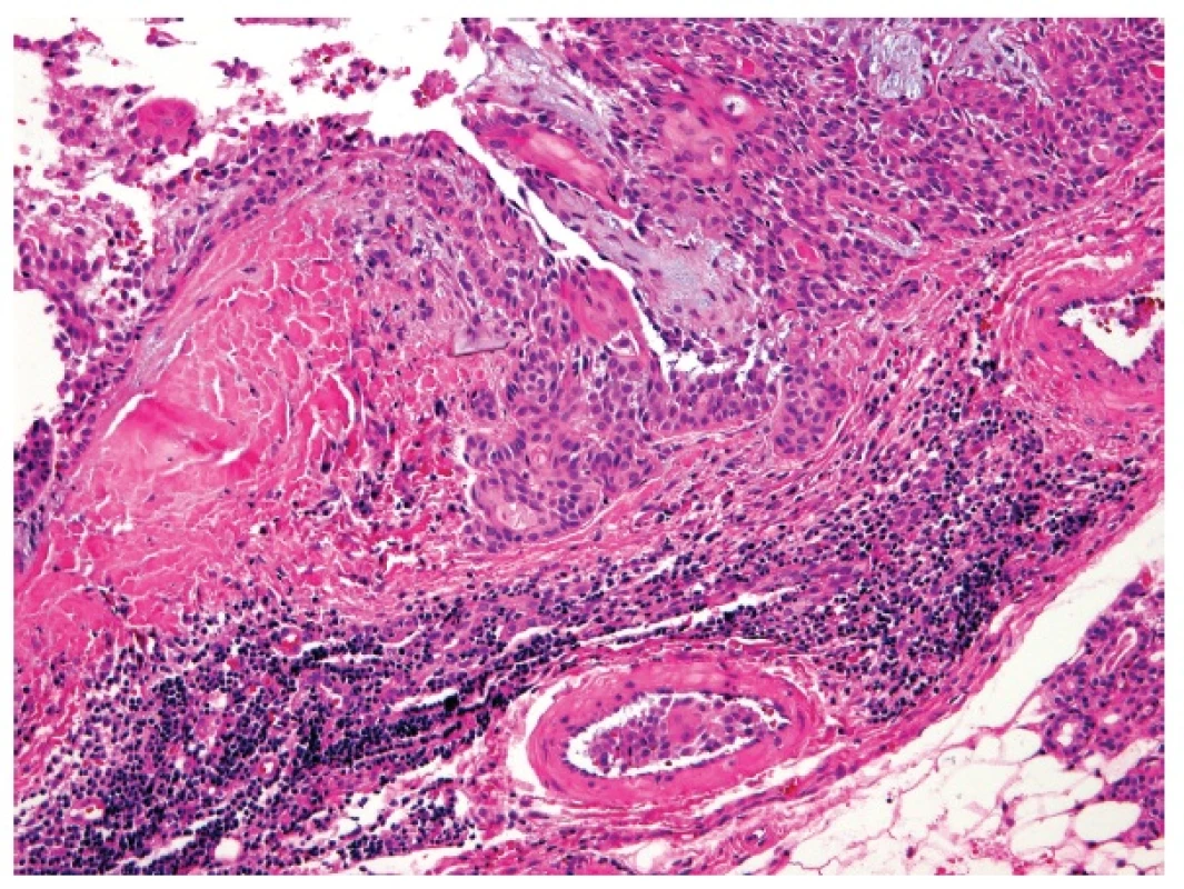 Pleomorfní adenom submandibulární žlázy: dilatované tlustostěnné cévy ve vazivové tkáni pseudopouzdra obsahují nádorová deposita. HE, 200x.