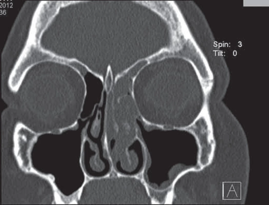 CT vyšetrenie prinosových dutín – koronárne rezy.