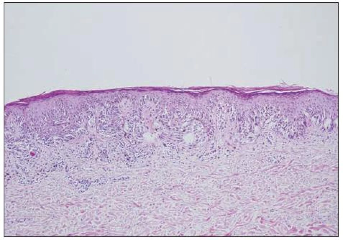 Névus junkční atypický.
Léze je symetrické, hnízda melanocytů ohraničená, někde splývají, fibrotizace vaziva kolem epidermálních čepů, vyzrávání melanocytů.