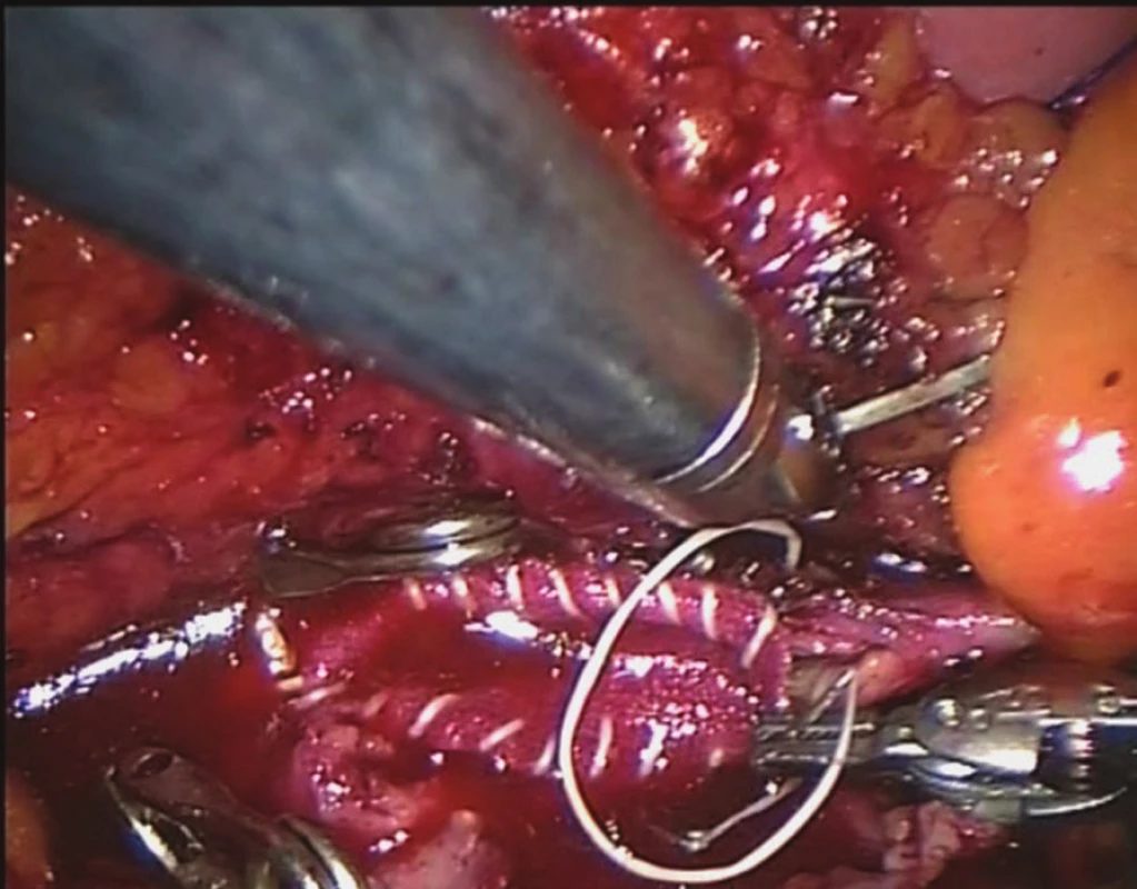 Tromboendarterektomie aorty