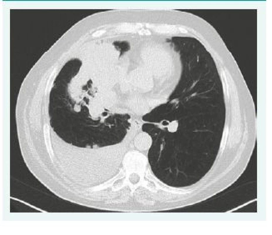 CT snímek pravého hemitoraxu s výpotkem a plicním karcinomem