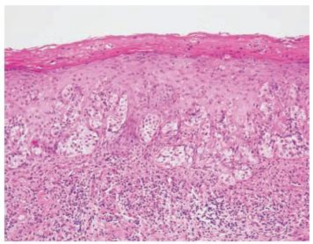 Veliké buňky se světlou cytoplazmou a zřetelným jádrem (Pagetovy buňky) jednotlivě nebo ve shlucích v rozsahu celé epidermis (HE, x200)