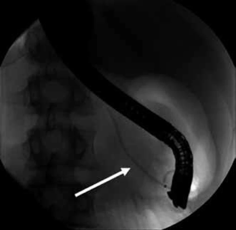ERCP – zavedený stent do hlavního pankreatického vývodu, pohled zezadu (šipka).
Fig. 4. ERCP – stent in the main pancreatic duct, view from behind (arrow).