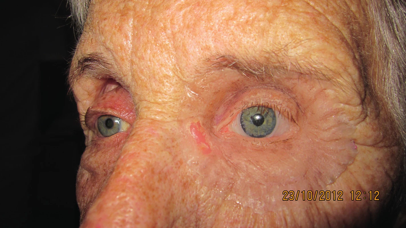 Detail tváre s nasadenou ľavou epitézou očnice