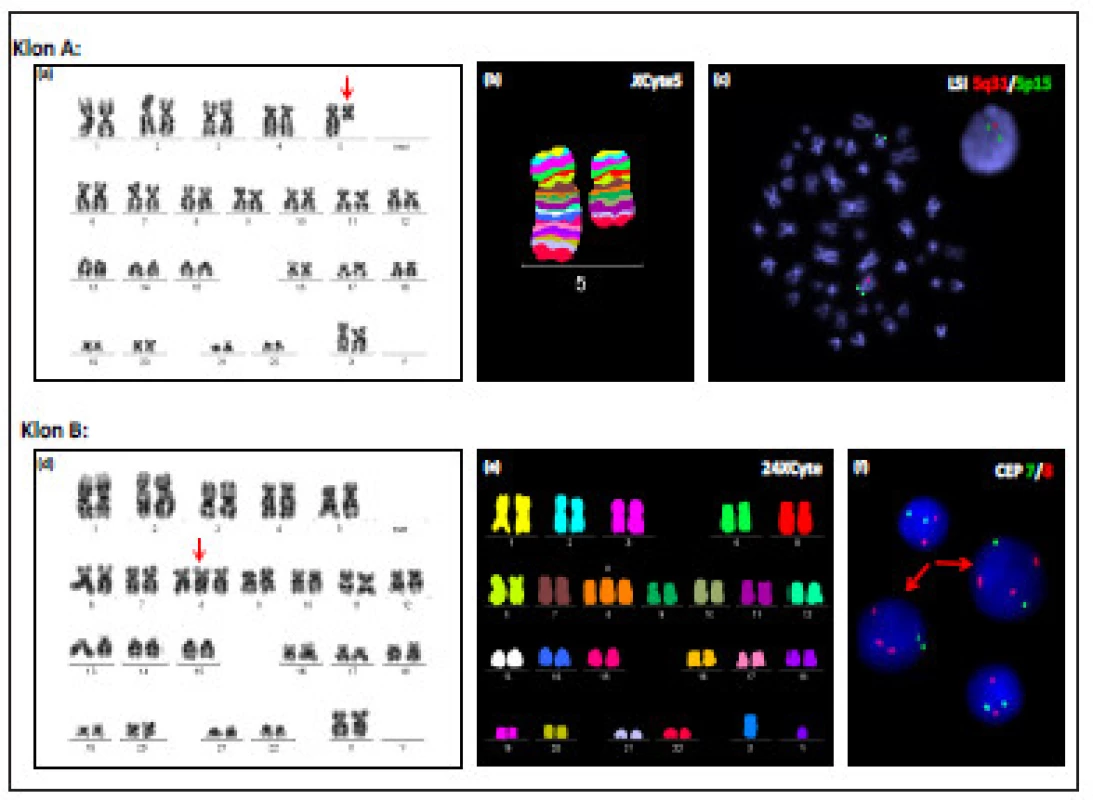 Výsledky cytogenetické a molekulárně cytogenetické analýzy nepříbuzných buněčných klonů u pacientky č. 5:
(a) Karyotyp s prokázanou delecí del(5)(q13q33) (klon A) získaný konvenční G-pruhovací technikou.
(b) Rozsah delece dlouhých ramen chromozomu 5 v klonu A byl ověřen metodou mBAND (použitá sonda XCyte 5, MetaSystems).
(c) Velikost patologického buněčného klonu s delecí 5q (klon A) byla ověřena metodou I-FISH (červeně značená oblast 5q31, zeleně značená kontrolní oblast 5p15.2; použitá sonda Vysis LSIEGR1(5q31)/ D5S23,D5S721(5p15), Abbott Molecular).
(d) Konvenční karyotyp klonu B s prokázanou trizomií chromozomu 8. 
(e) Karyotyp buňky s trizomií chromozomu 8 (klon B) analyzovaný metodou mFISH (sonda 24XCyte, MetaSystems).
(f) Velikost nepříbuzného buněčného klonu s trizomií chromozomu 8 (klon B) byla ověřena metodou I-FISH s centromerickými sondami pro chromozom 8 (červený signál) a 7 (zelený signál). Buňky s trizomií 8 jsou označeny šipkami (sonda Vysis CEP 8/7).