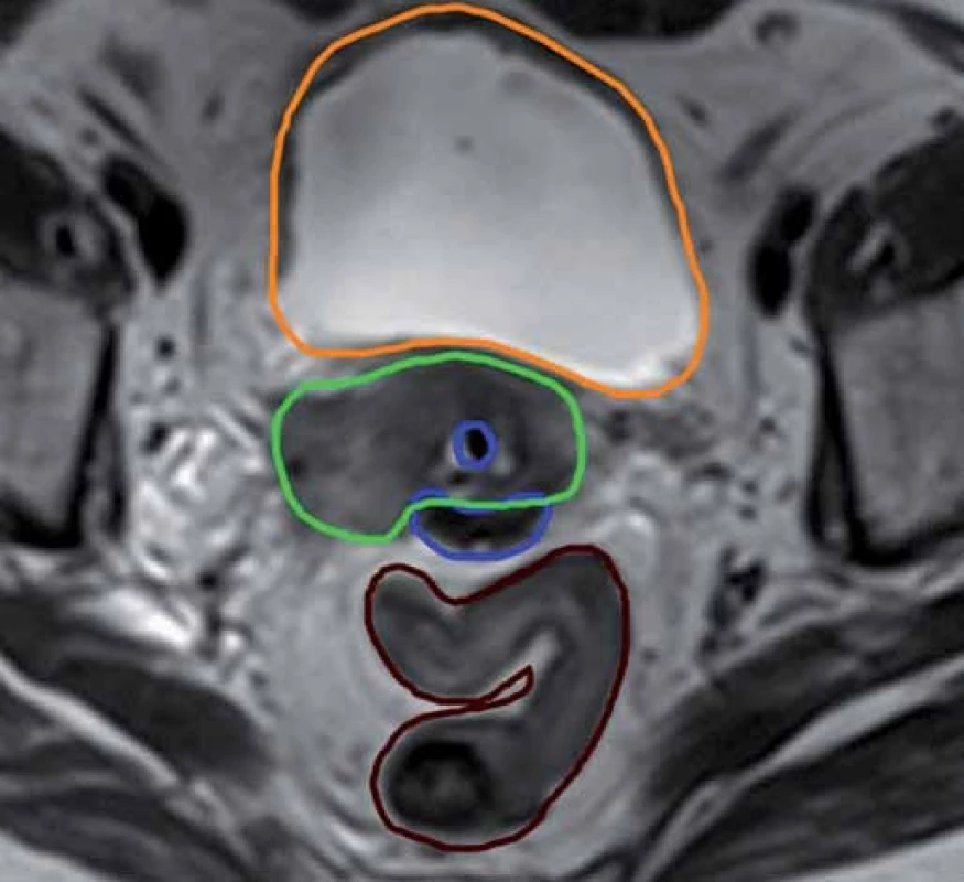 Konturace cílového objemu podle MRI vyšetření. Zelená barva – HR CTV, modrá – aplikátor, oranžová – močový měchýř, hnědá – sigmoideum.