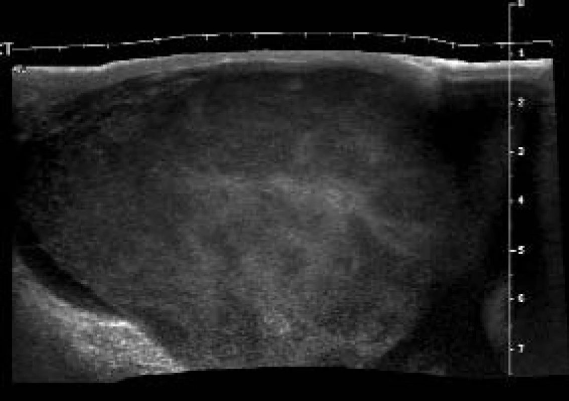 USG skrota. Objemné zvětšení varlete při infiltraci lymfomem. Jedná se o tzv. panoramantické USG-zobrazení, které vzniká při složení více jednotlivých obrazů a využívá se při zobrazovaní orgánů, které jsou větší než zobrazované pole sondy.