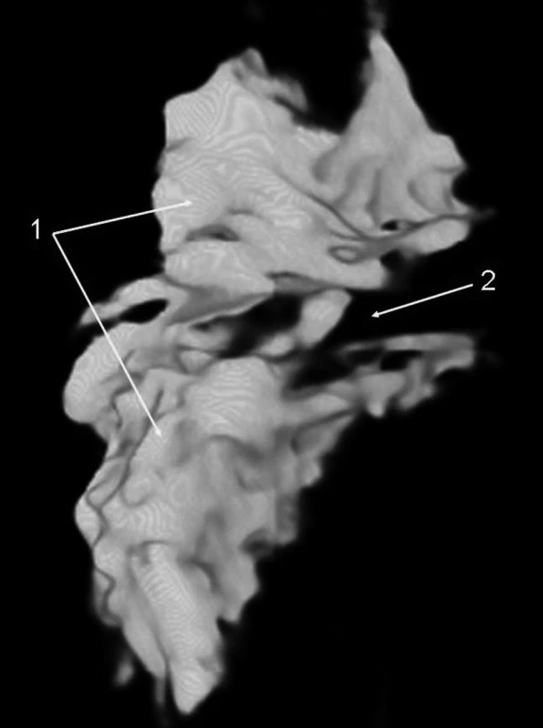 Infraklavikulární blok, 35 ml kontrastní látky
3D rekonstrukce CT vyšetření, mediální pohled na fascii brachiálního plexu, zářez zprava je způsoben existencí m. infraclavicularis.
1 – 3D náplň infraklavikulárního prostoru (pohled z mediální strany)
2 – otisk m. infraclaviscularis