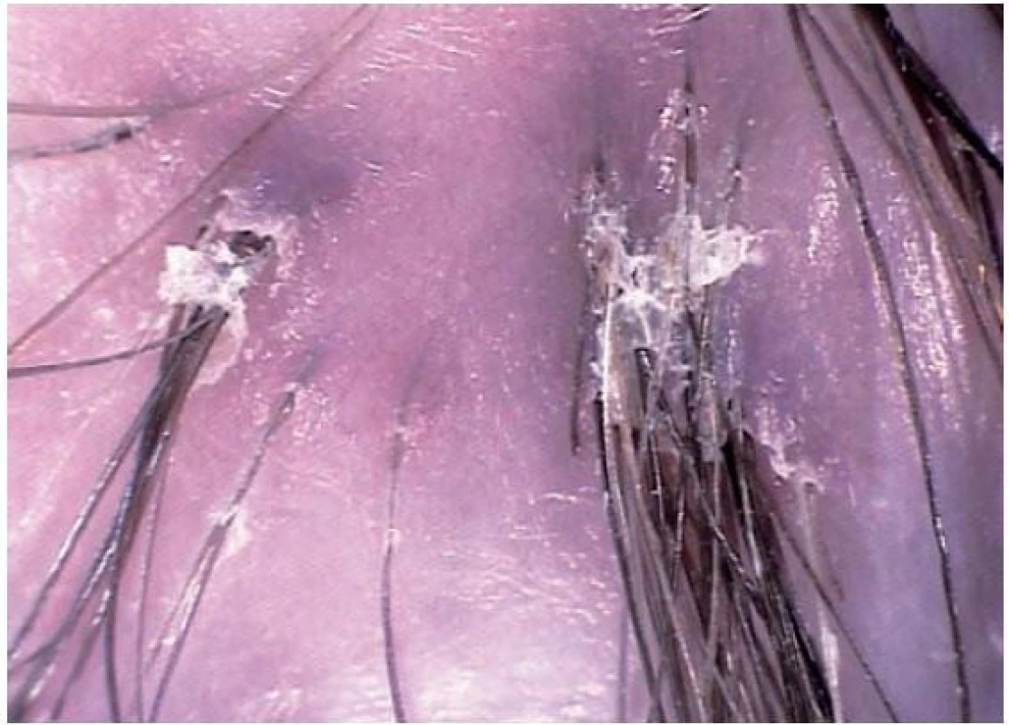 Jizvící alopecie – tufted hairs s šupinami a erytémem kolem folikulárního ústí u folliculitis decalvans