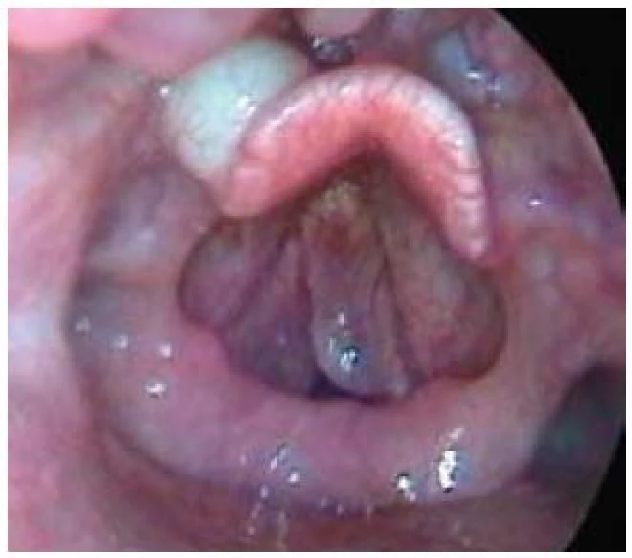 Cysta levé glossoepiglotické valekuly (kromě toho je přítomný na obou hlasivkách Reinkeho edém).
Fig. 9. Cyst of the left glossoepiglottic vallecula (Reinke’s oedema of both vocal cords is also present).