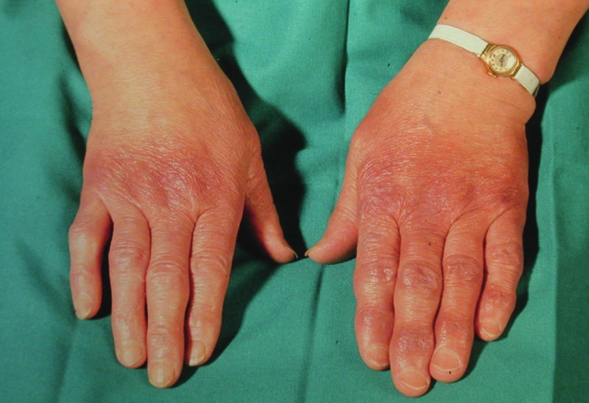 Acrodermatitis chronica atrophicans – dorza rukou
