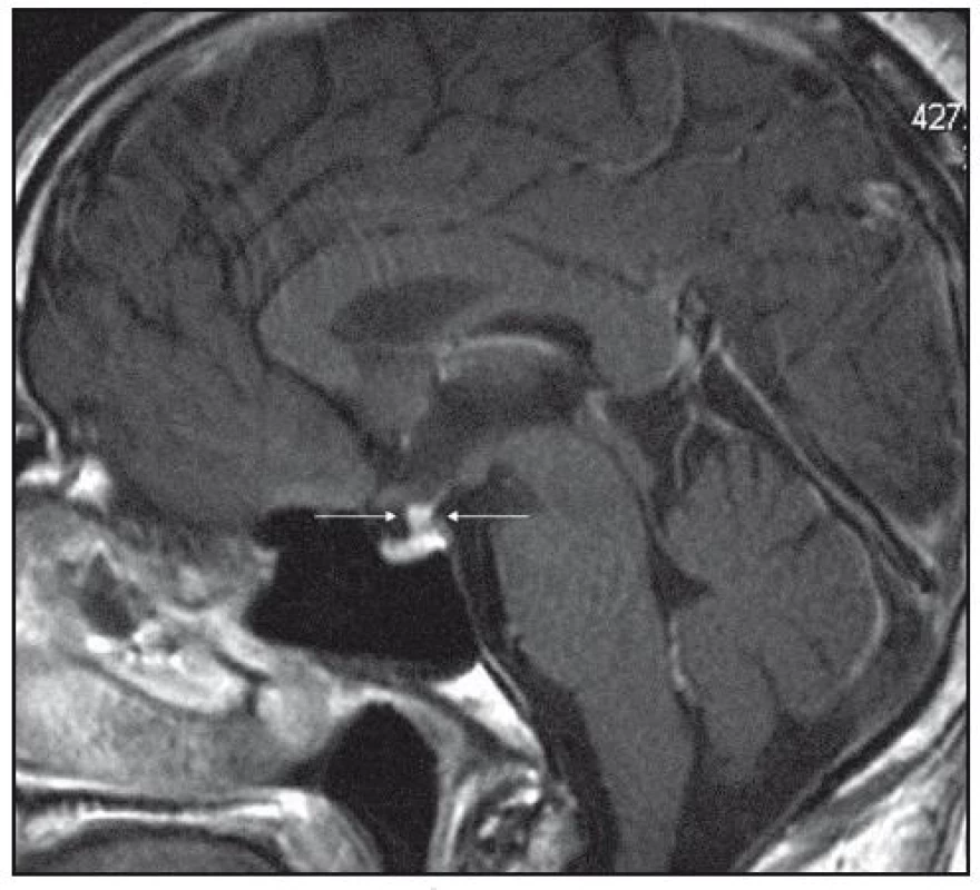 MR mozku v roce 2006: postkontrastně se sytící ložiskové zbytnění stopky hypofýzy, T1 vážený obraz po aplikaci kontrastní látky, sagitální rovina.
