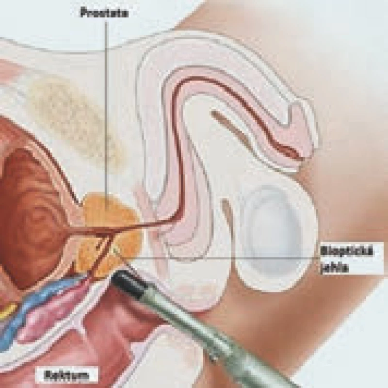 Biopsie prostaty s využitím TRUS.