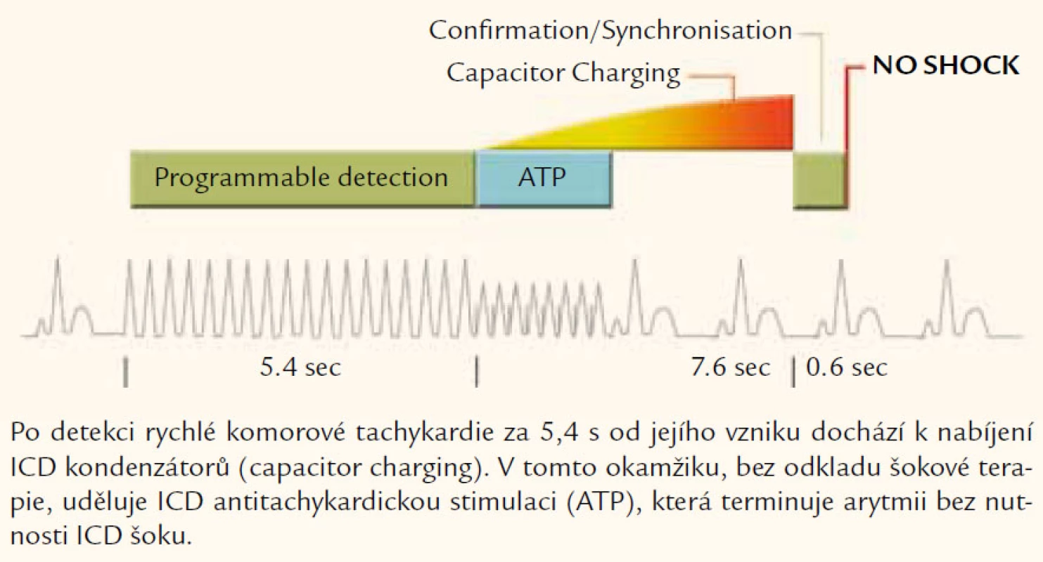 Udělení ATP u rychlé komorové arytmie – funkce firmy Medtronic.
