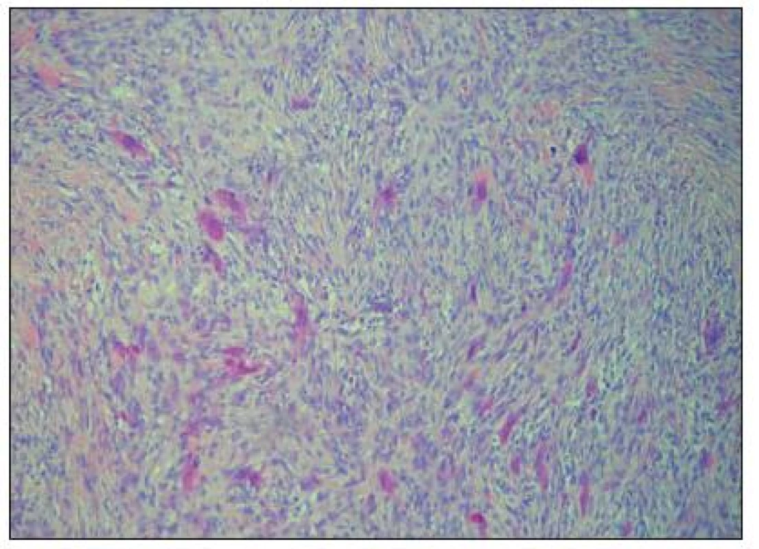 Storiformně uspořádaná hypercelulární část nádoru z vřetenitých buněk a obrovských vícejaderných buněk (barveno hematoxylin-eozinem, originální zvětšení 100×)