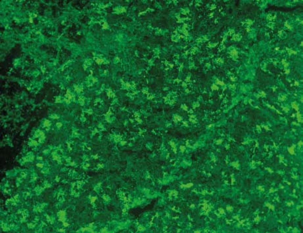 Protilátky proti exokrinnímu pankreatu, PAB. Nepřímá imunofluorescence, substrát: opičí pankreas (Euroimmun, SRN ). Mikroskop: Olympus BX51, objektiv UPlan FI 40×. Kapkovité extracelulární (luminální) útvary a granulární cytoplazmatická fluorescence v acinárních buňkách. &lt;sup&gt;©&lt;/sup&gt;Ing. Miroslav Hinďoš, ÚLBLD VFN a 1. LF UK.
Fig. 1. Antibodies against exocrine pancreas, PAB. Indirect immunoflorescence; substrate mankye´s pancreas; (Euroimmun, Germany): Droplike (luminal) formation and granular cytoplasmatic florescence in the acinar cells. (Ing Miroslav  Hinďoš, ÚLBLD VFN a 1. LF UK).