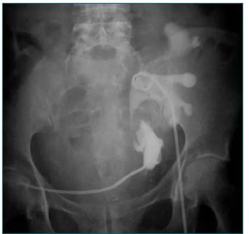 Urinózna fistula.
Močovod transplantovanej obličky poranený pri perkutánnej drenáže lymfokély.
