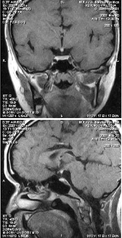 Postkontrastný (k.l. gadolínium-DTPA) T1 vážený obraz pri vyšetrení magnetickou rezonanciou u pacientky č. 3 – a) koronárny rez, b) sagitálny rez