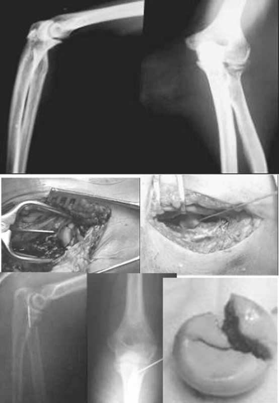 Zlomenina typu Mason III ošetrená extrakorporálne osteosutúrou vstrebateľným Vicrylom a následne topicky replantovaná ako spacer s transfixáciou Kirschnerovym drôtom