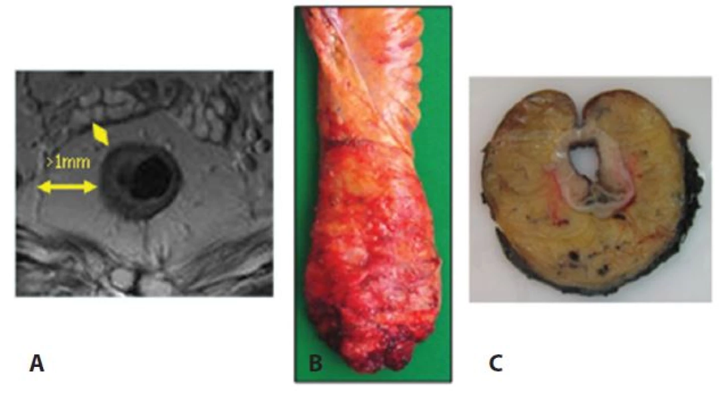 Negativní cirkulární resekční okraje v zobrazení MRI (A), resekát rekta s kompletní excizí mezorekta (B) a příčná lamela rekta v místě nádoru (C)
Fig. 1: Negative circular resection margins based on MRI (A); rectal biopsy with complete mesorectal excision (B); and the transverse lamella of the rectum at the tumor site (C)
