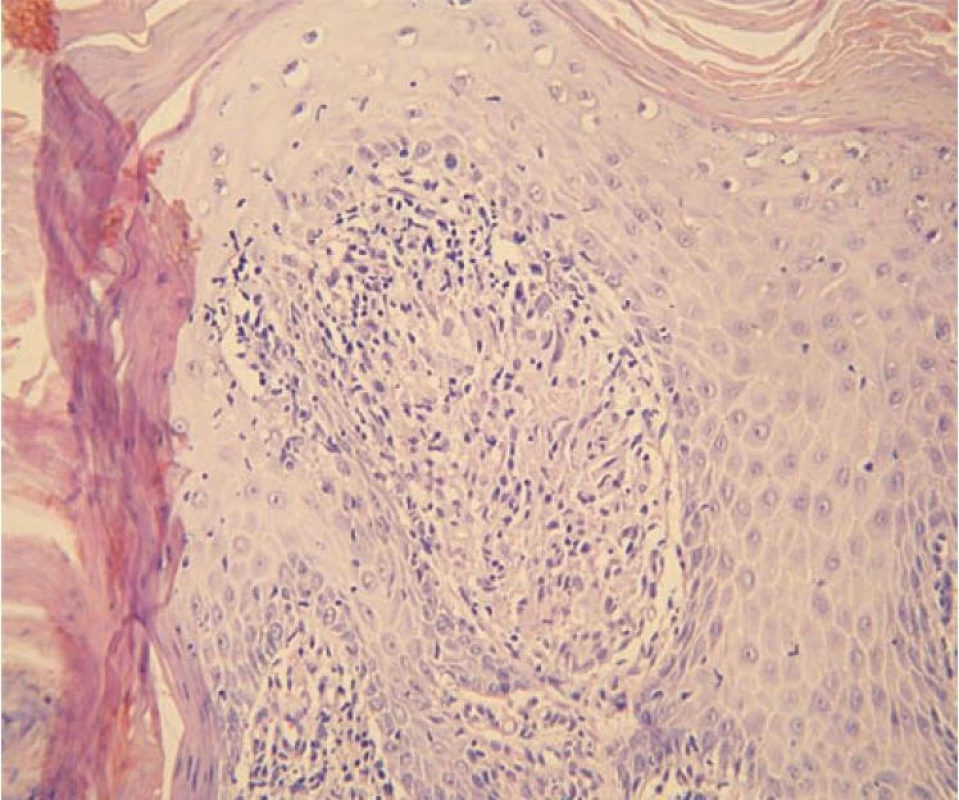 Detail dermální papily obsahující granulom z epiteloidních histiocytů bez centrální nekrózy, s malým lymfocytárním pláštěm, tedy ne zcela typický lupoidní granulom (hematoxylin-eosin, zvětšení 200krát)
