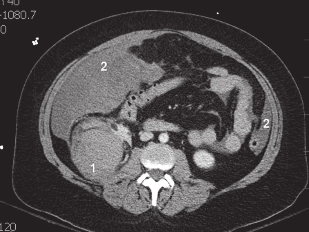 CT vyšetření pacientky před operační revizí. Na snímku je patrný tumor pravé ledviny (1) a hemoperitoneum (2).
Fig. 1. CT scan of the patient before surgical revision. There is evident right kidney tumor (1) and haemoperitoneum (2) on the pictur.