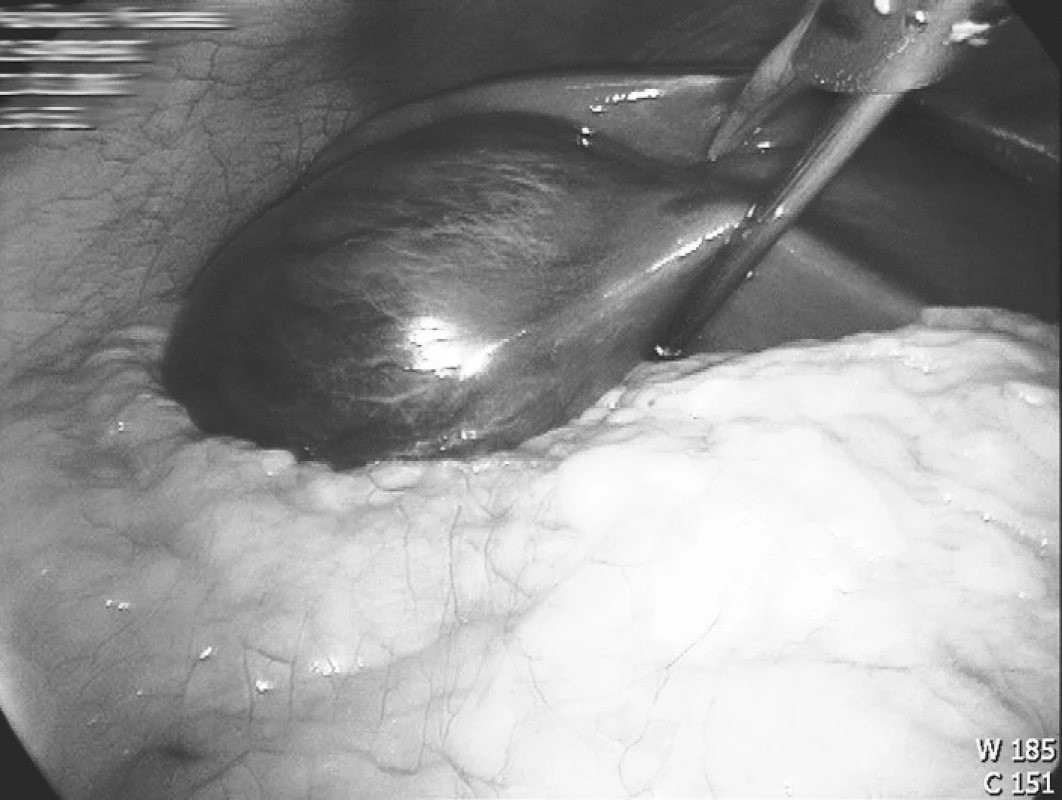 Fokální nodulární hyperplazie levého laloku jaterního
Fig. 1. Focal nodular hyperplasia of the left liver lobe
