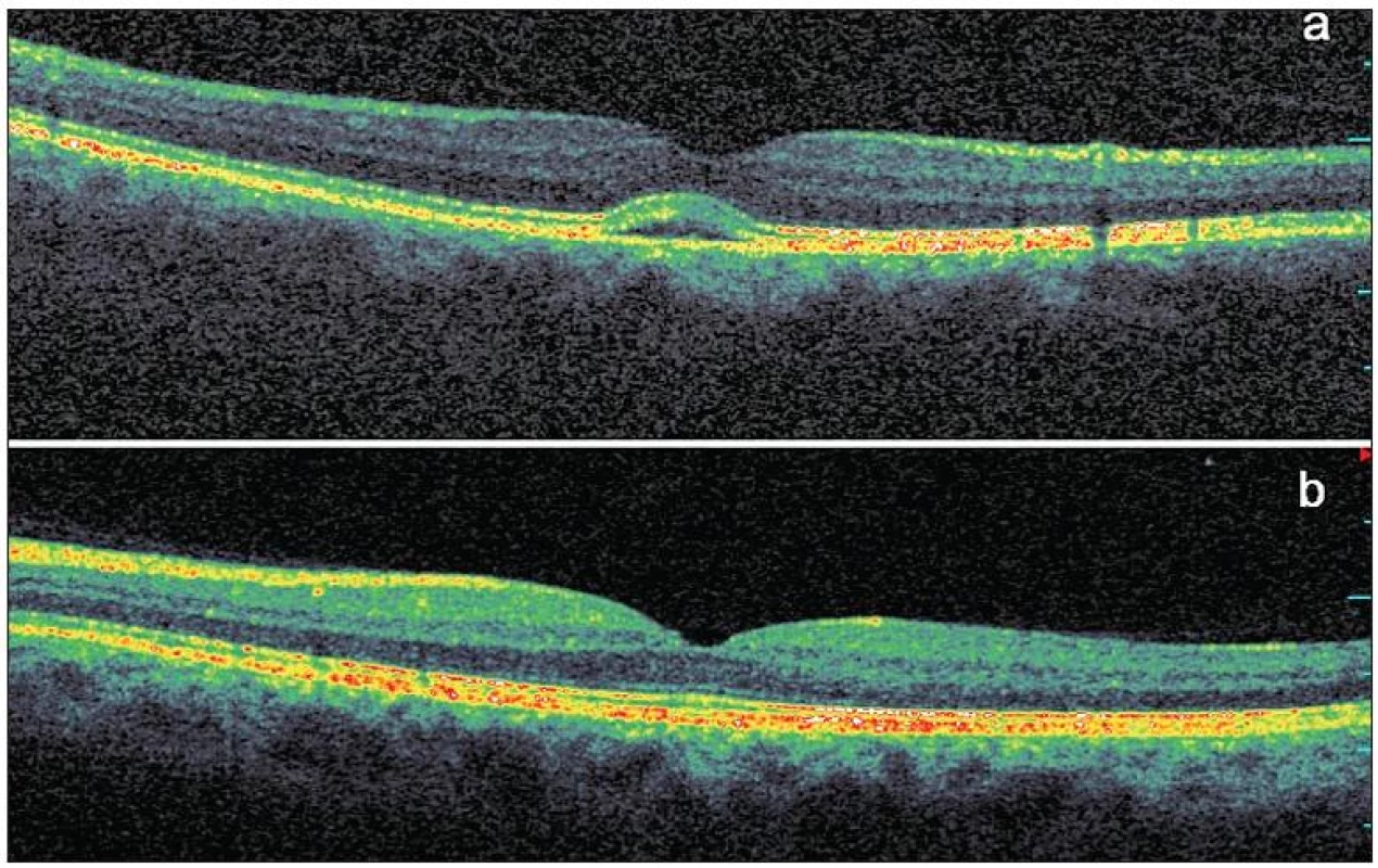Optická koherenční tomografie se spektrální doménou u asymptomatického pacienta s Bestovou chorobou. V makule pravého oka se nachází subfoveolárně lokalizovaná oblast se štěrbinovým prostorem velmi nízké nehomogenní reflexivity mezi hyperreflexivním pruhem retinálního pigmentového epitelu a rozhraním fotoreceptorů, mírně je oslabena zevní jaderná vrstva, ostatní vrstvy sítnice se jeví normální a foveolární deprese je zachována a), v makule levého oka je normální nález b)