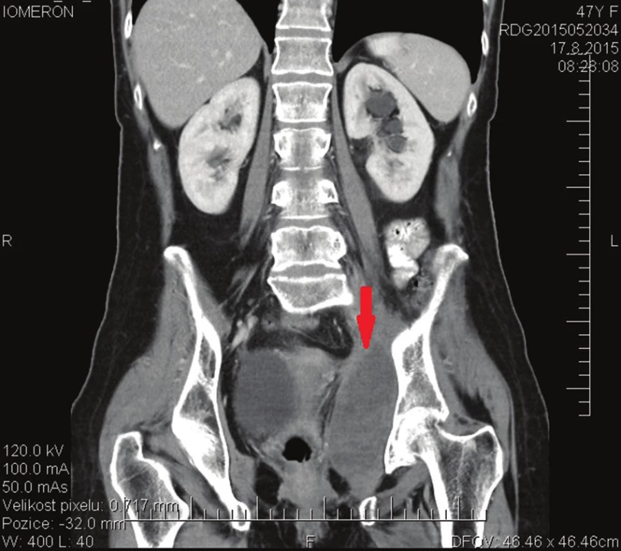 CT vyšetření po R2 resekci ve druhé době
Fig. 3: CT scan after the second line R2 resection