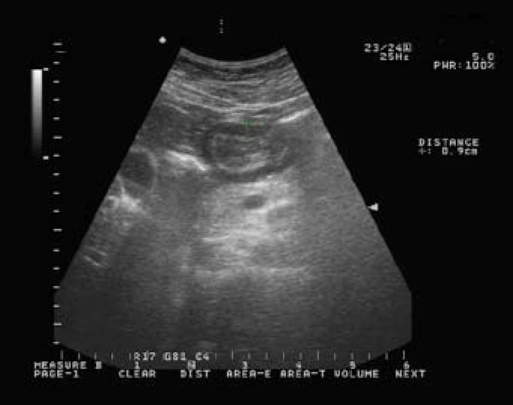 Sonografický obraz rozšíření stěny žaludku.
Fig. 4. Thickening of the stomach wall in abdominal ultrasonography.