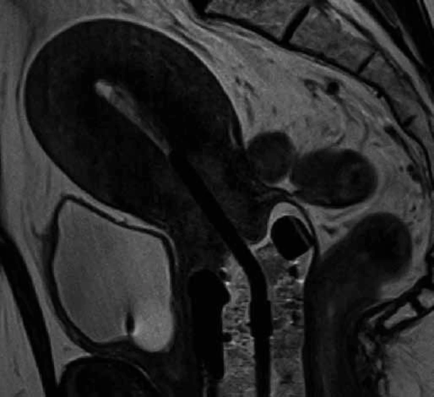 T2 sekvence MRI vyšetření s uterovaginálním aplikátorem – sagitální rovina. V děložním čípku patrný hyperintenzivní tumor, pochva vyplněná tamponádou.