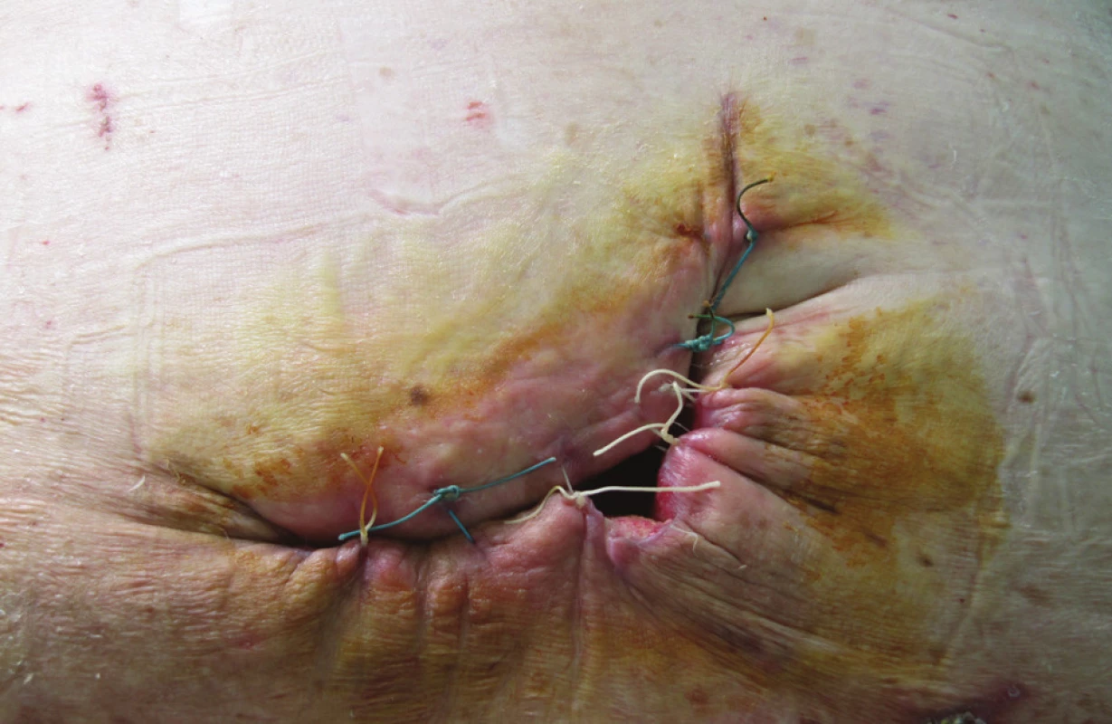Měsíc po operaci
Fig. 7. One month after the surgery